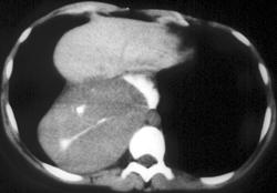 Leiomyoma of the Esophagus - CTisus CT Scan