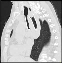 Esophageal Cancer Invades Mediastinum With Stents in Trachea and Esophagus - CTisus CT Scan