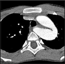 Ectatic Aorta Compresses the Esophagus - CTisus CT Scan