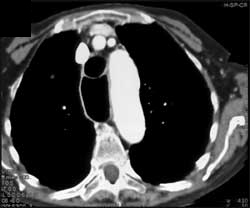 Dilated Esophagus and Achalasia - CTisus CT Scan