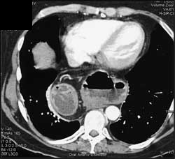 Para-esophageal Hernia - CTisus CT Scan