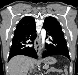 Esophageal Cancer With Mediastinal Nodes - CTisus CT Scan