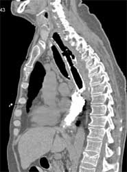 Stent in Place With Perforation - CTisus CT Scan