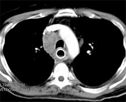 Bulky Esophageal Cancer With Adenopathy - CTisus CT Scan