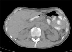 Nodes From Esophageal Cancer - CTisus CT Scan