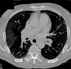 Stent in Trachea Due to Esophageal Cancer - CTisus CT Scan