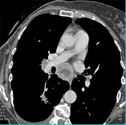 Esophageal Cancer With Nodes - CTisus CT Scan