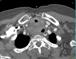 Ulcerating Esophageal Cancer Infiltrating Mediastinum - CTisus CT Scan