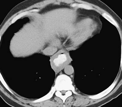 Esophageal Cancer with Celiac Adenopathy - CTisus CT Scan
