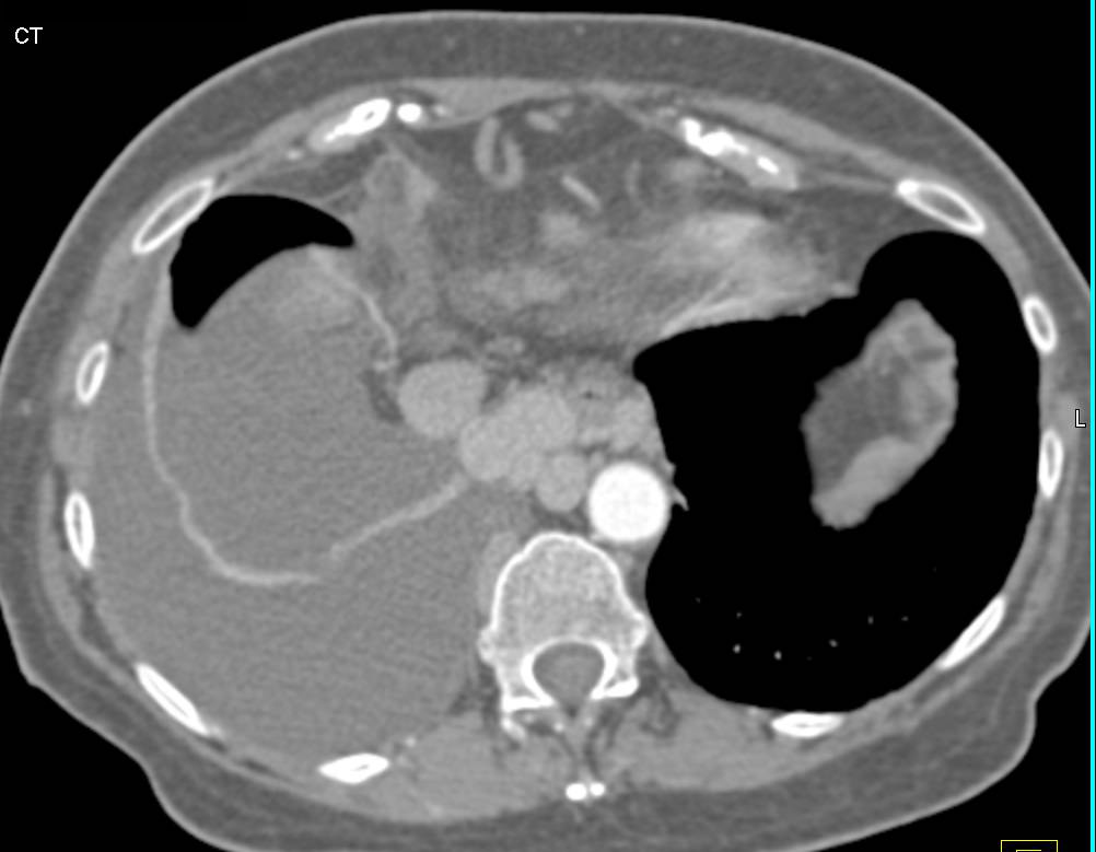 TE Fistulae in Upper Third of Esophagus in Cirrhotic Patient - CTisus CT Scan