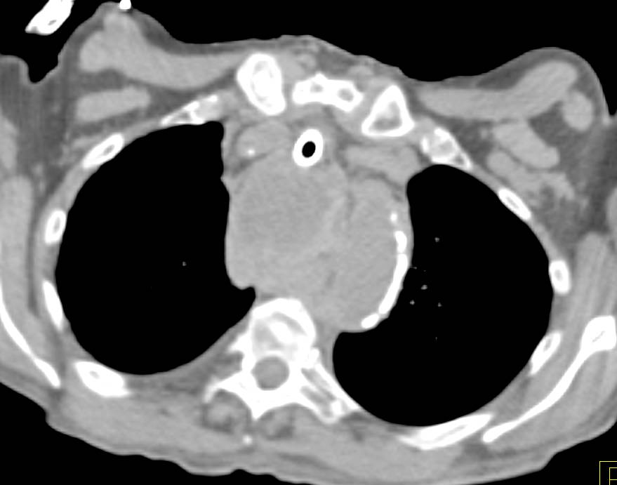 Bulky Esophageal Cancer Invades the Trachea - CTisus CT Scan