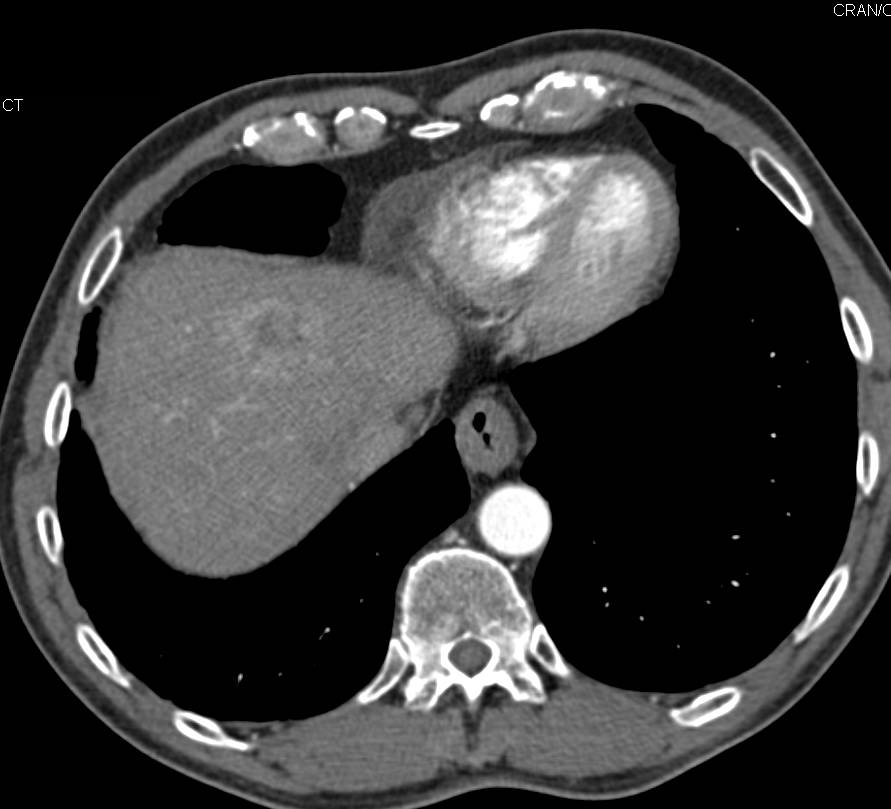 Esophageal Cancer with Liver Metastases and Implants in the Pelvis - CTisus CT Scan