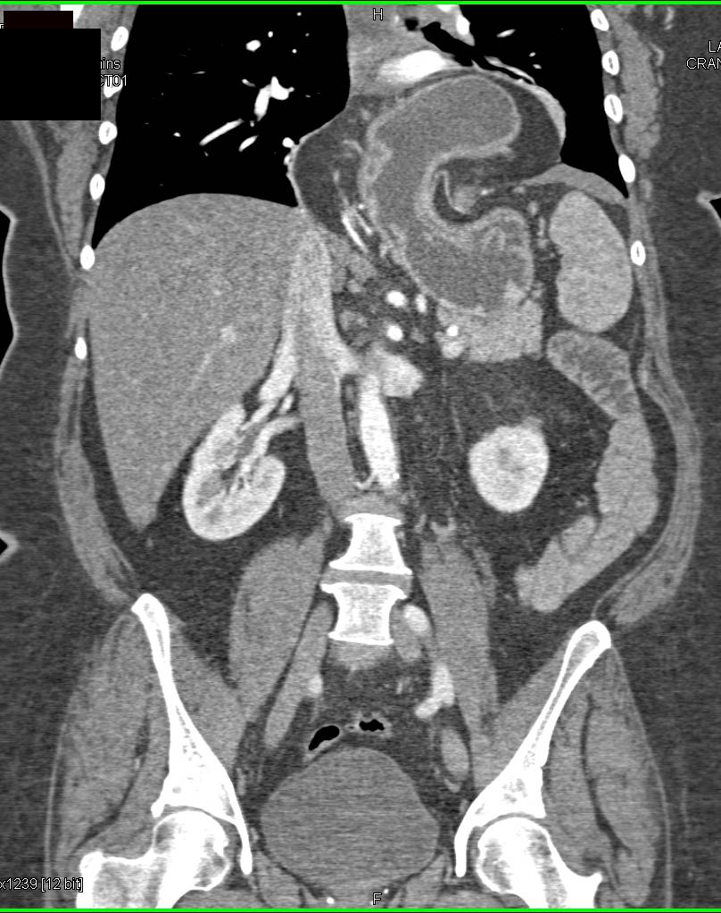 Large Hiatal Hernia that can Lead to a Gastric Volvulus - CTisus CT Scan