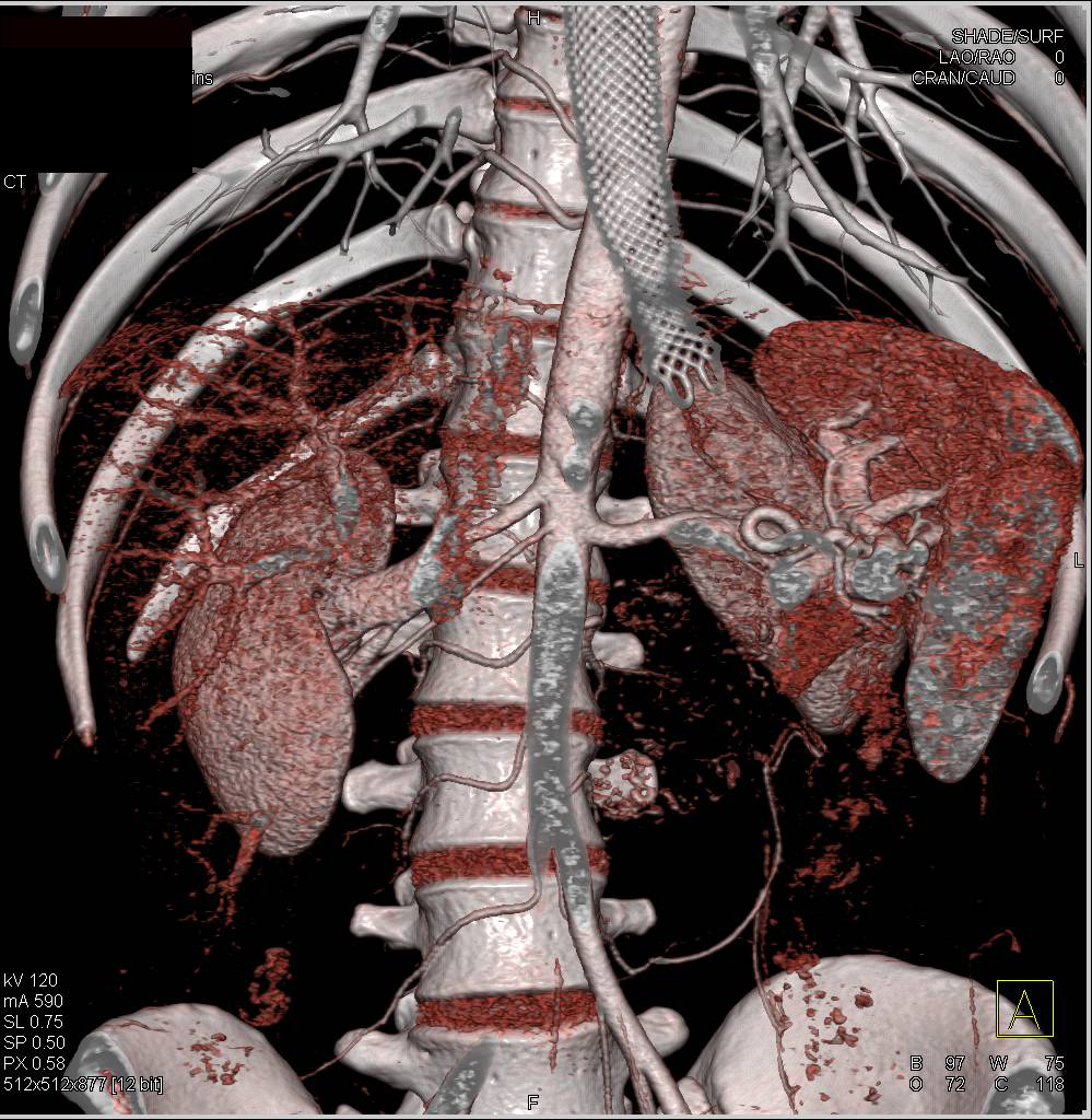 mediastinal-germ-cell-tumor-involves-the-esophagus-with-adenopathy