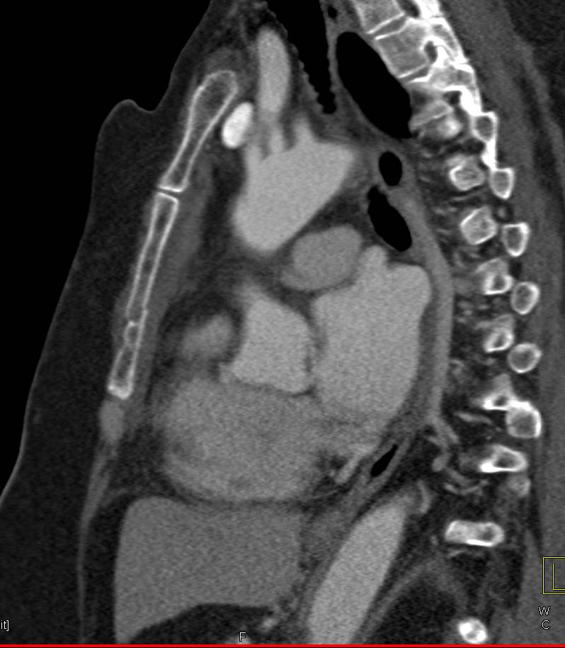 Esophagitis - CTisus CT Scan