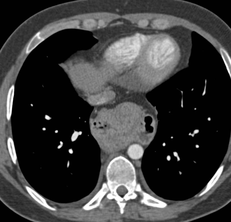 Paraesophageal Hiatal Hernia - CTisus CT Scan