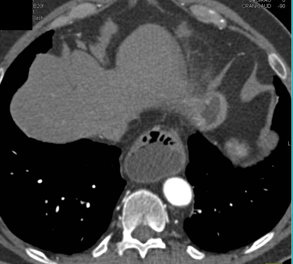 Large Hiatal Hernia - Esophagus Case Studies - CTisus CT Scanning