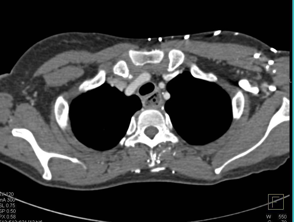 Severe Esophagitis in an Immunosuppressed Host - CTisus CT Scan
