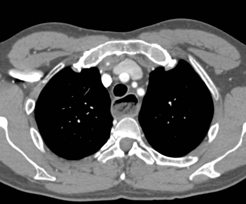 Achalasia with a Dilated Esophagus till the Gastroesophageal (GE) Junction - CTisus CT Scan