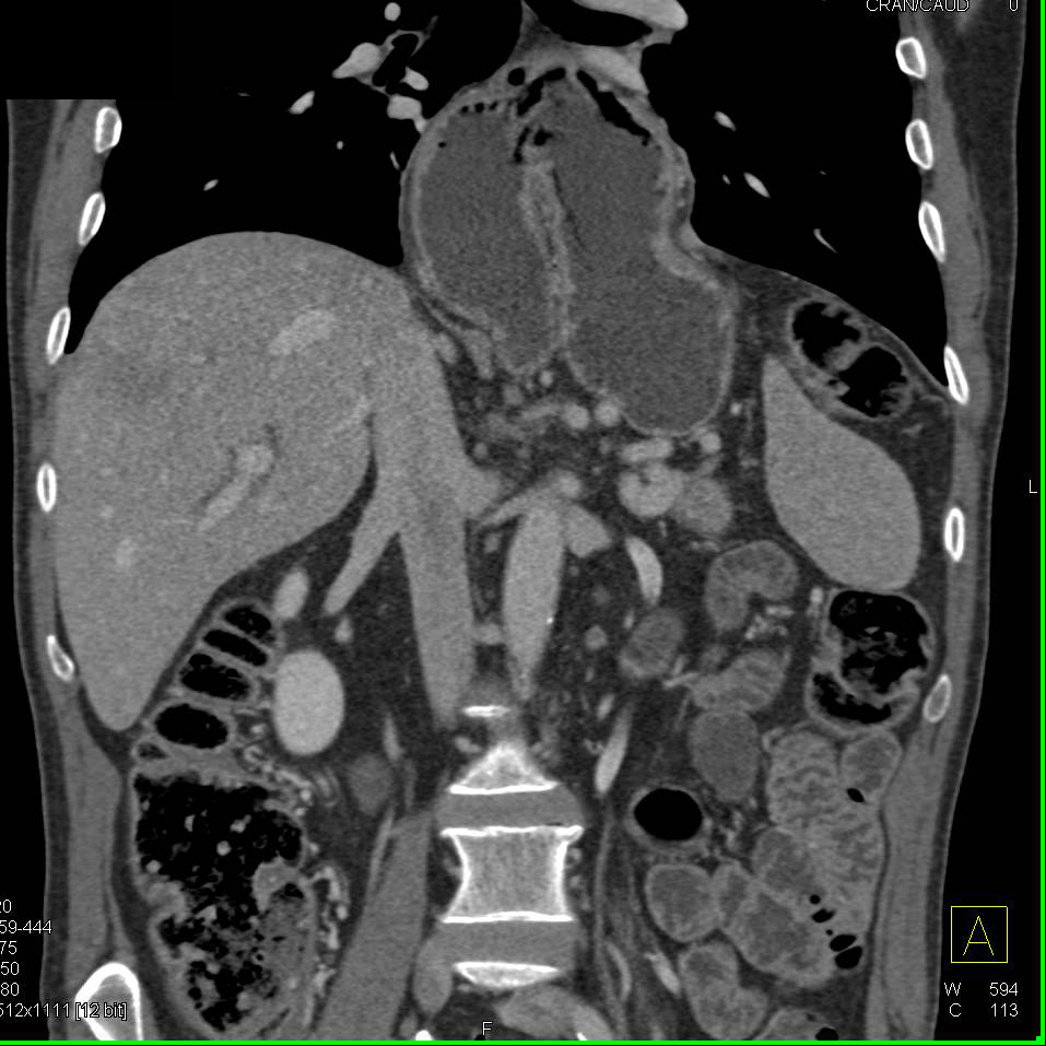 Paraesophageal Hernia with Evolving Volvulus - CTisus CT Scan