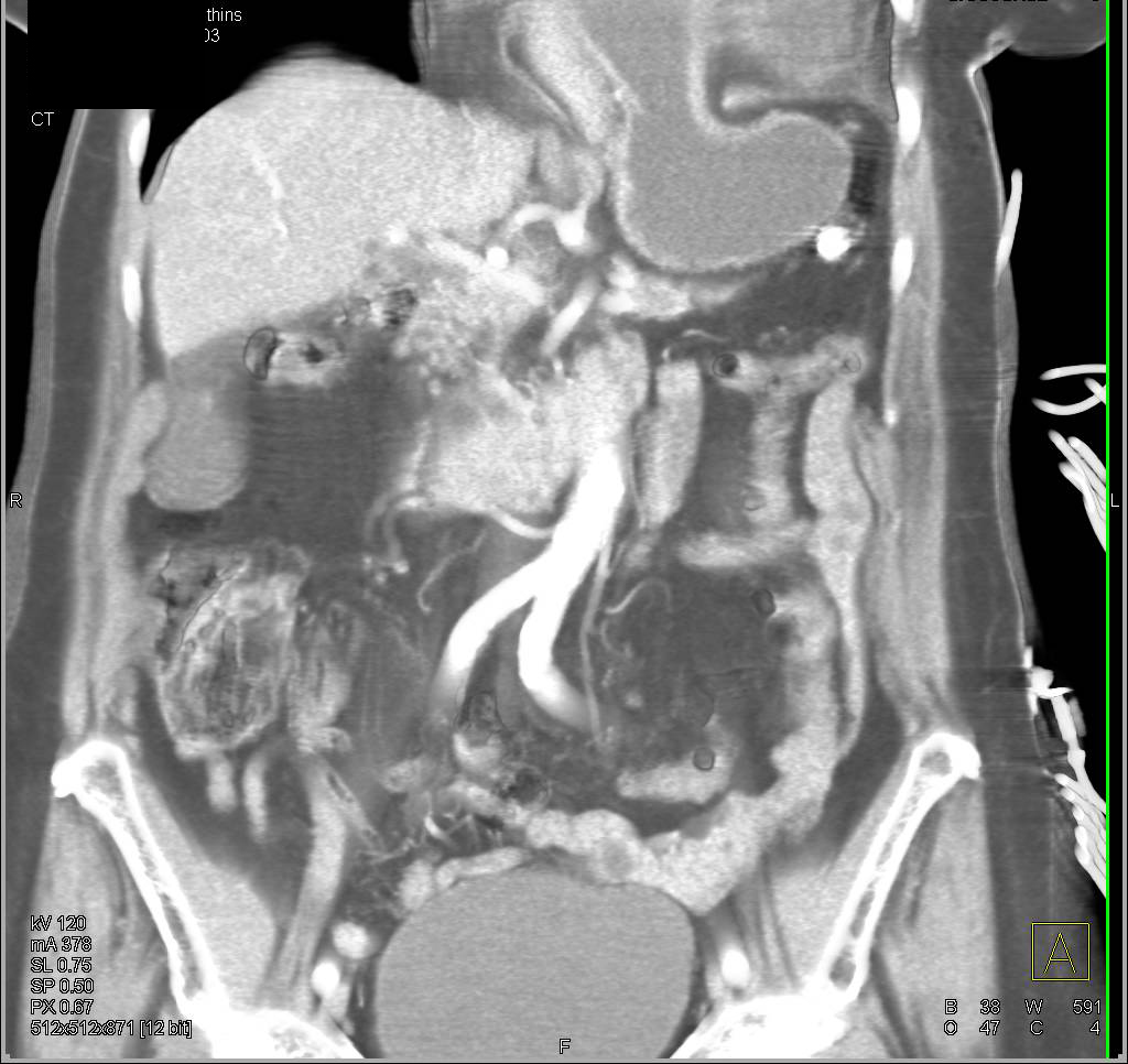 Paraesophageal Hernia with Evolving Volvulus - CTisus CT Scan