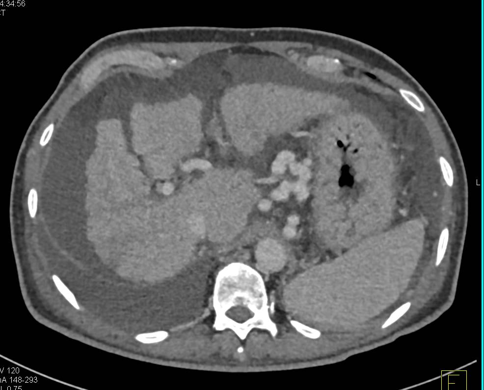 cirrhosis-with-large-esophageal-varices-esophagus-case-studies