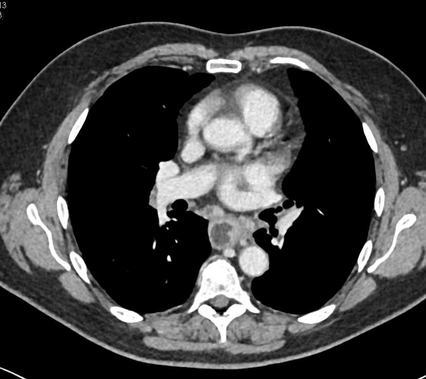 Esophageal Cancer in a Hiatal Hernia - CTisus CT Scan