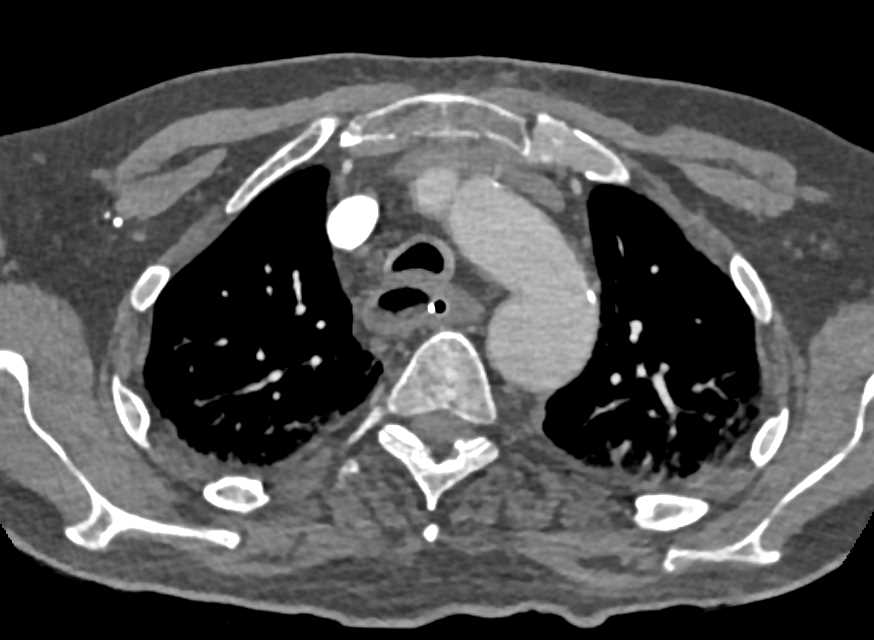 Esophagitis - CTisus CT Scan
