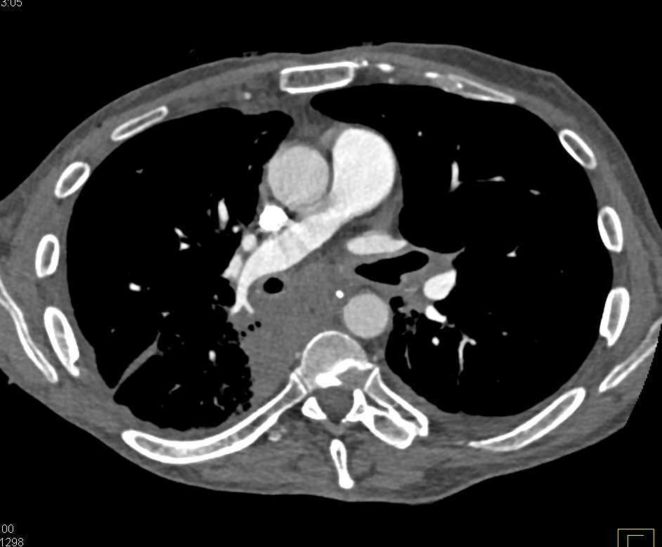 Esophageal Cancer with Pullup - CTisus CT Scan