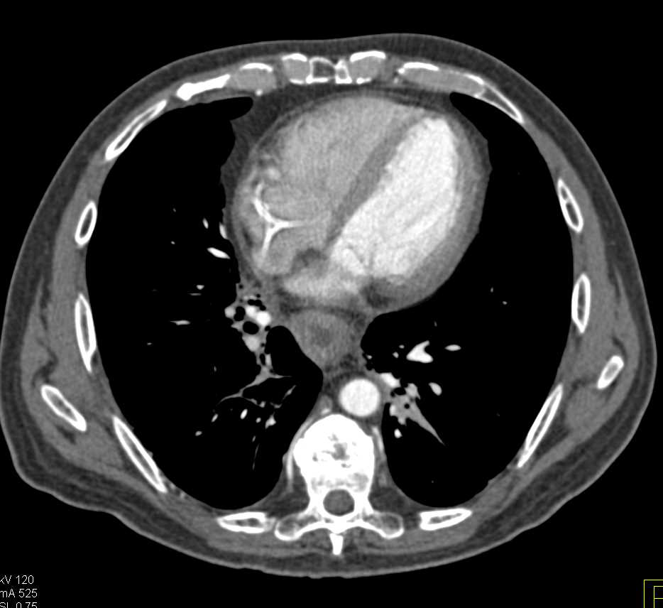 Carcinoma Near EG Junction with Celiac Adenopathy - CTisus CT Scan