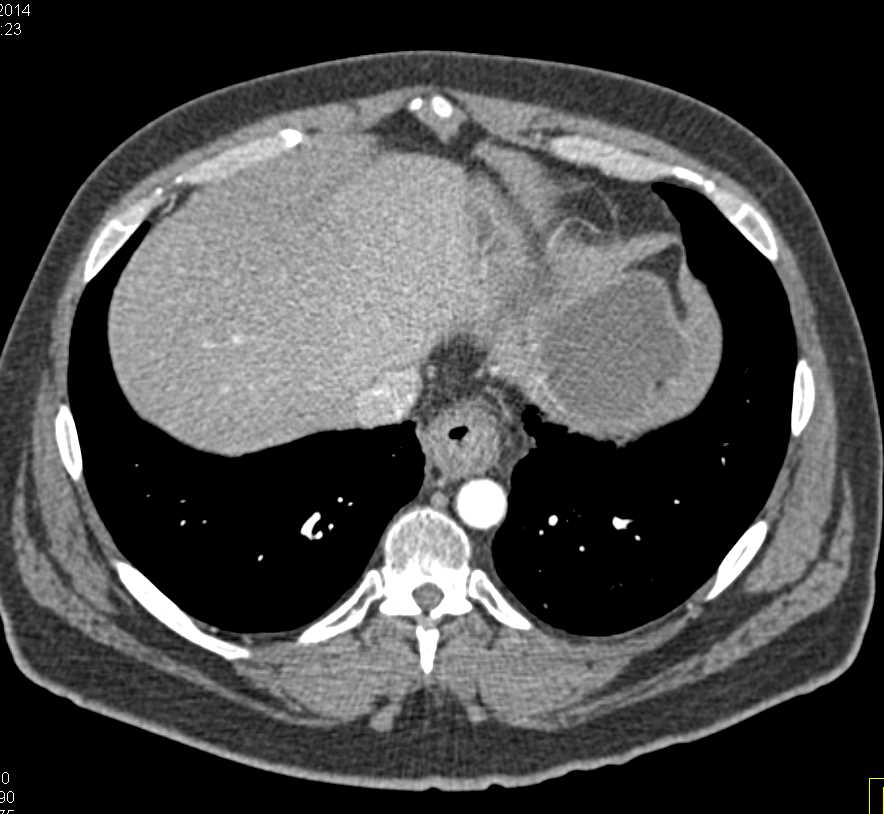 Esophageal Cancer with Nodes - CTisus CT Scan