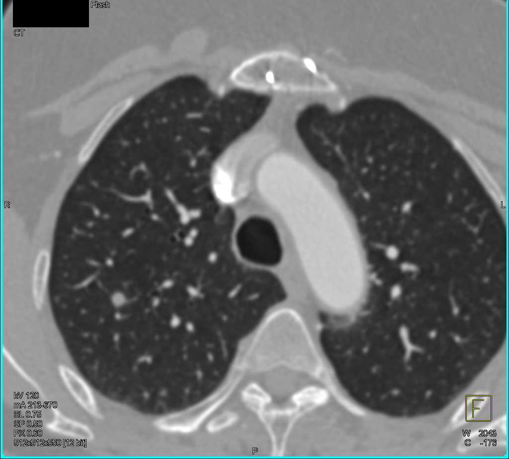 Esophageal Cancer with Nodes - CTisus CT Scan