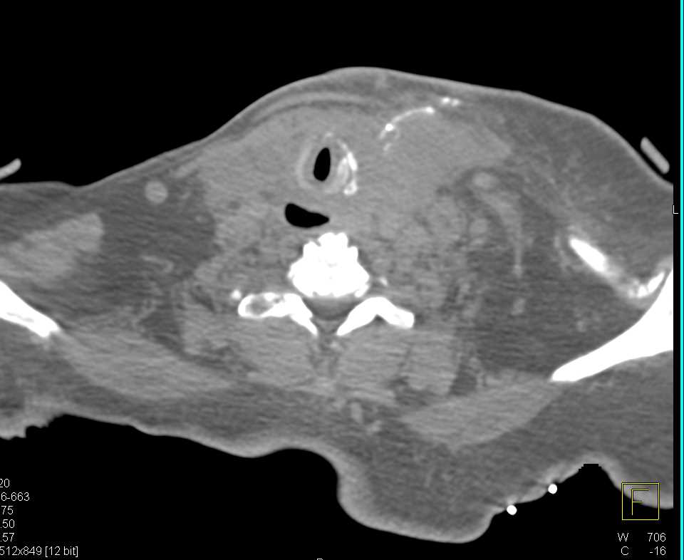 Fistulae with Abscess Involves the Trachea and the Esophagus - CTisus CT Scan