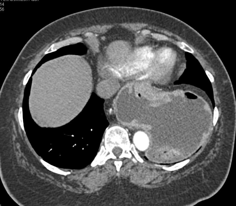 Large Para-Esophageal Hiatal Hernia - CTisus CT Scan