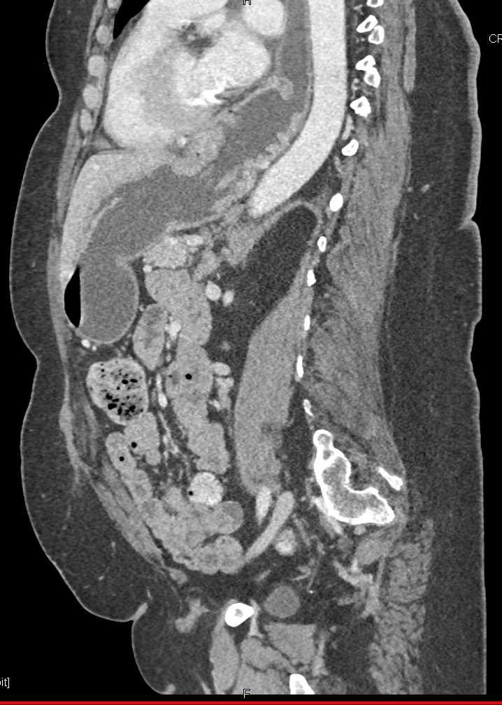 Large Hiatal Hernia Esophagus Case Studies Ctisus Ct Scanning - Vrogue