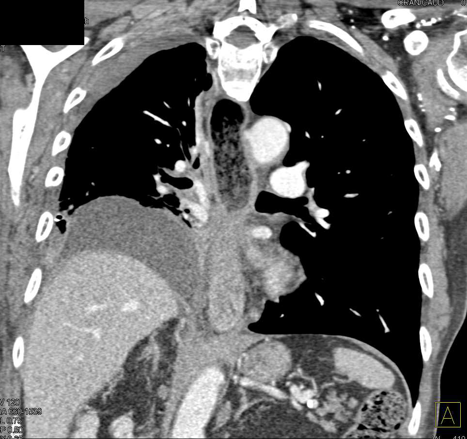 Carcinoma of the Distal Esophagus with Obstruction - CTisus CT Scan