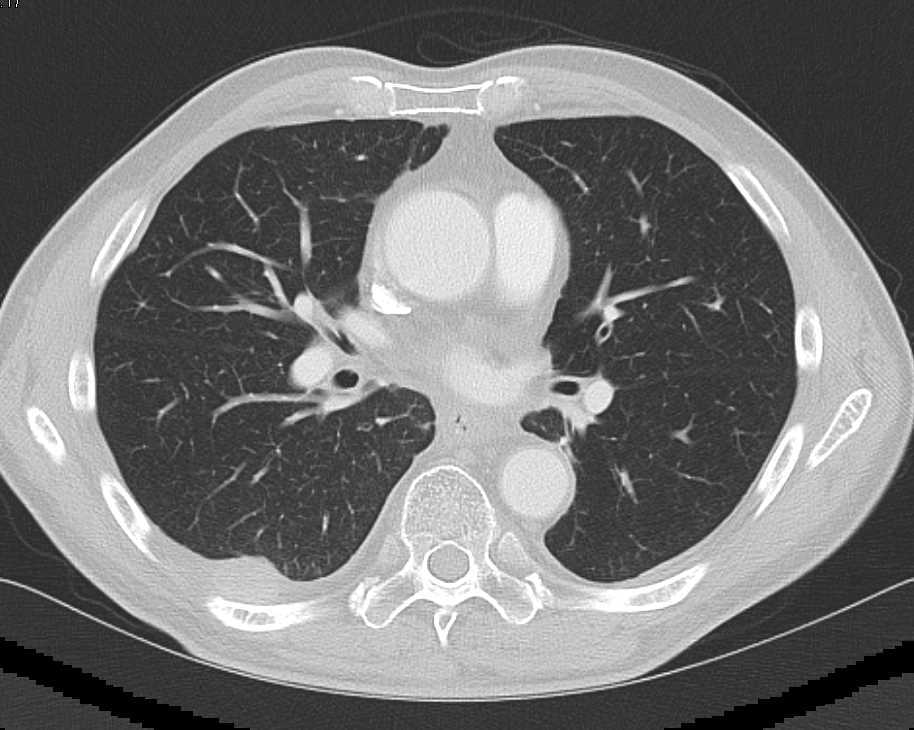 Esophageal Carcinoma with Liver and Lung Metastases - CTisus CT Scan