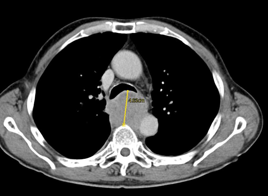 Esophageal Cancer with Widespread Metastases - CTisus CT Scan