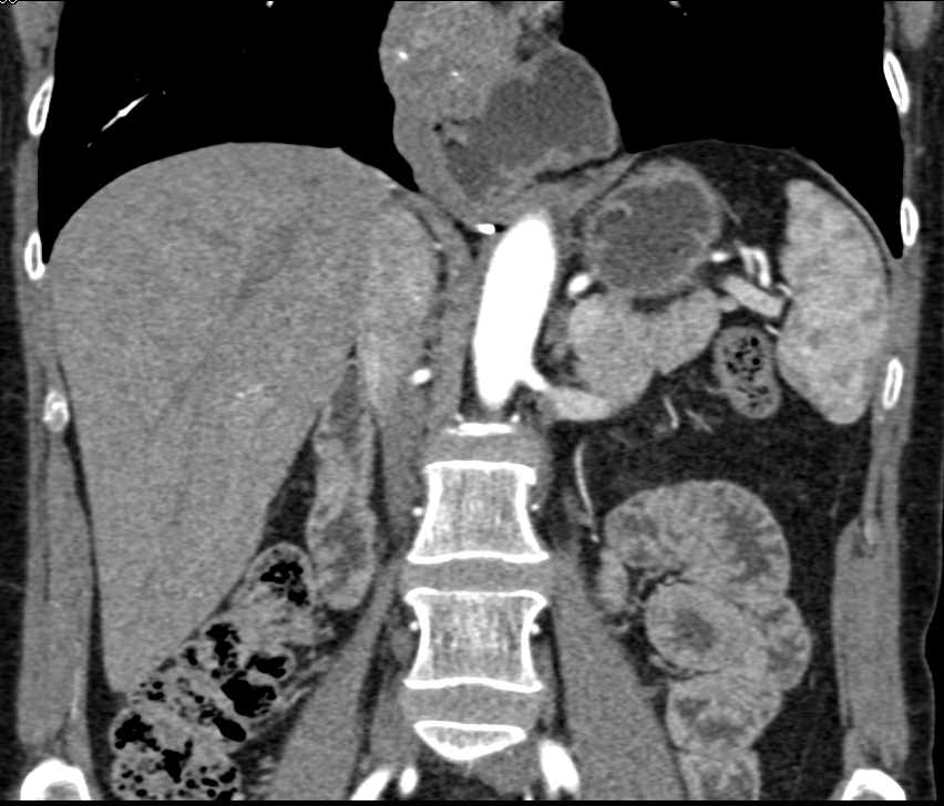 Esophageal Cancer - CTisus CT Scan