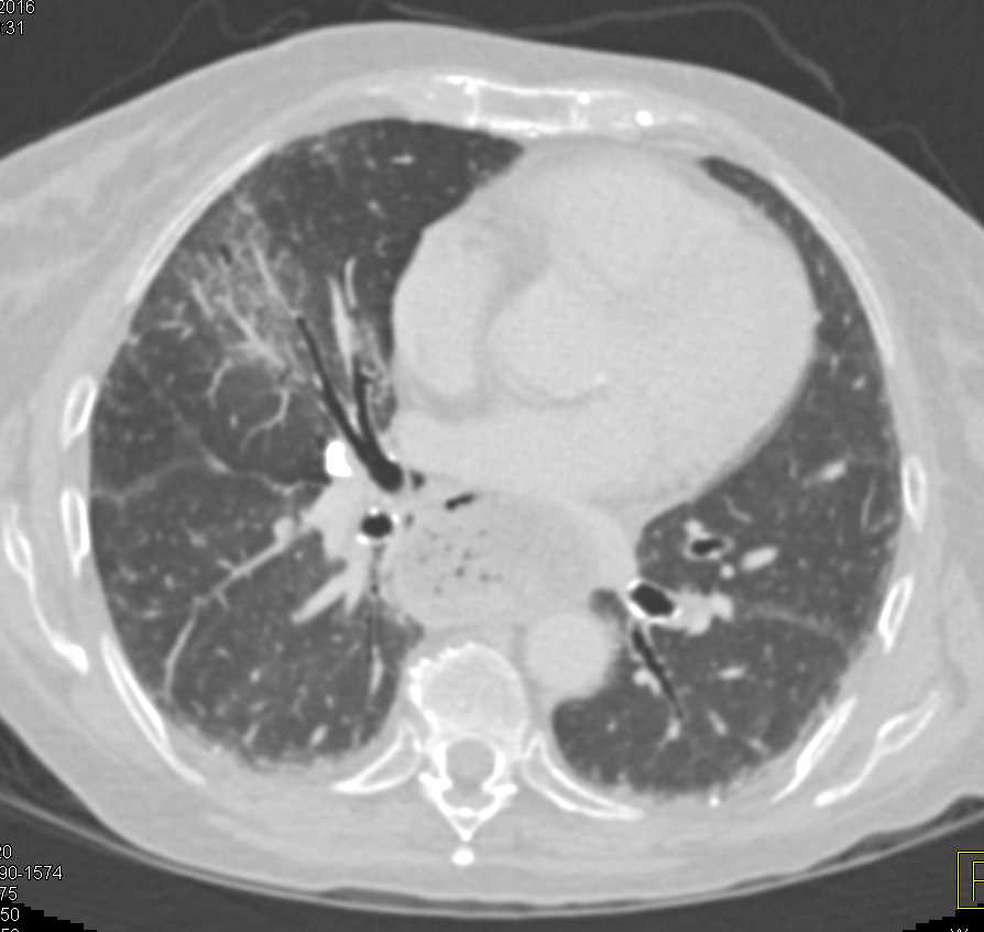 Achalasia - CTisus CT Scan