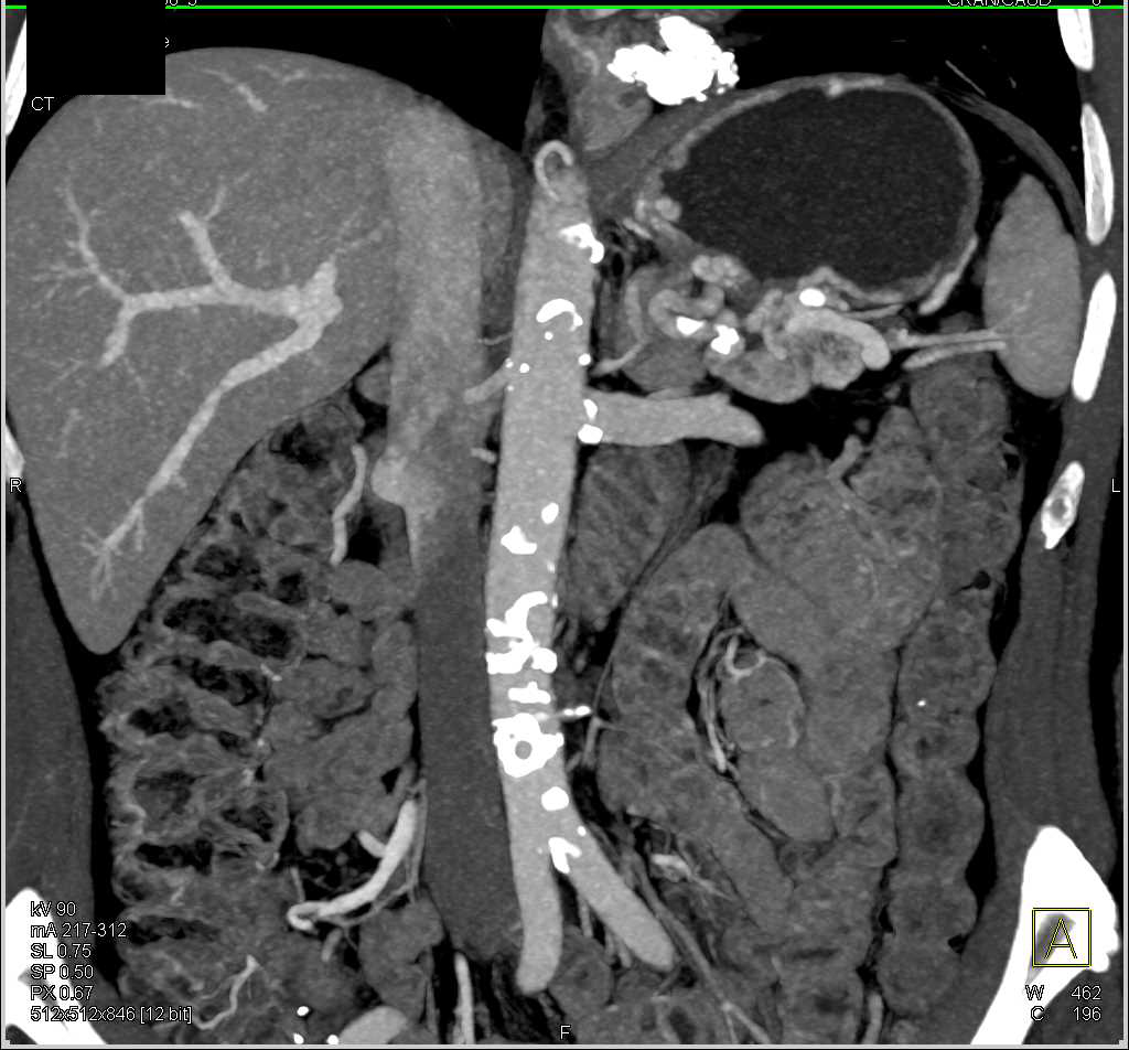 Esophageal Cancer with Calcifications - CTisus CT Scan