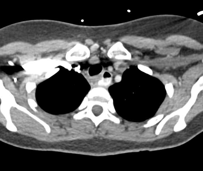 Perforated Esophagus due to Fishbone - CTisus CT Scan