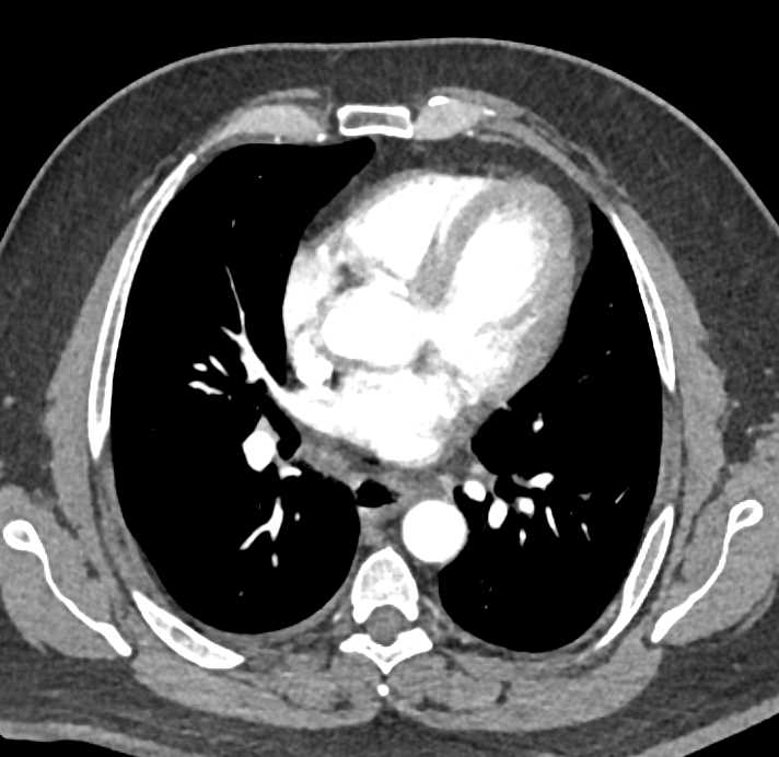 Esophageal Cancer - CTisus CT Scan