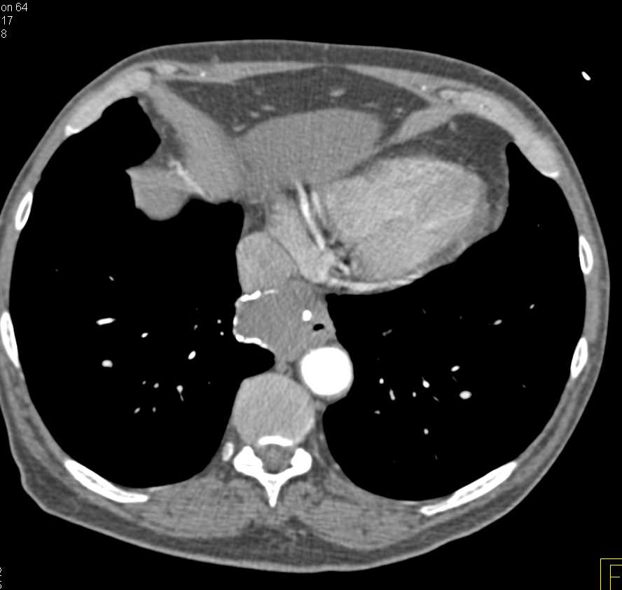 Leiomyoma Esophagus - CTisus CT Scan