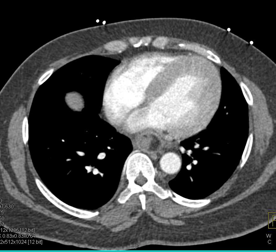 Patient Swallowed Steak and It is Obstructing the Esophagus - CTisus CT Scan