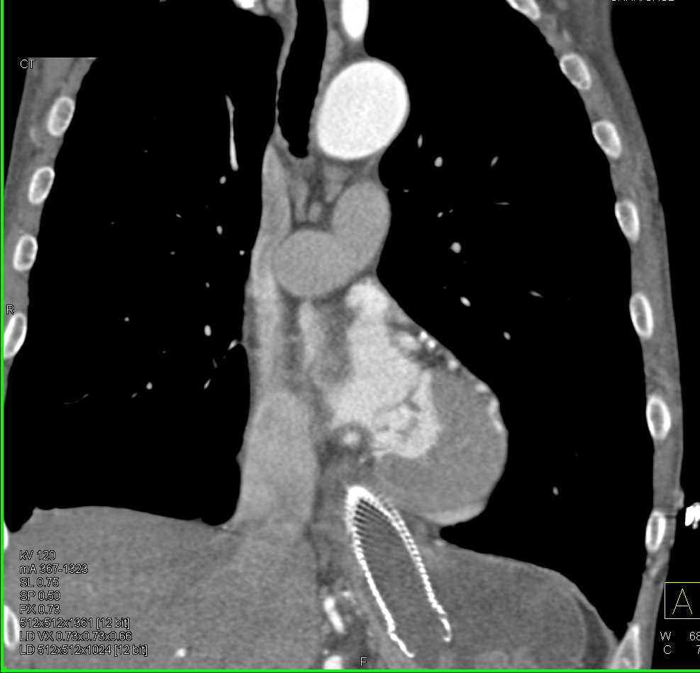 Esophageal Cancer with Stent - CTisus CT Scan