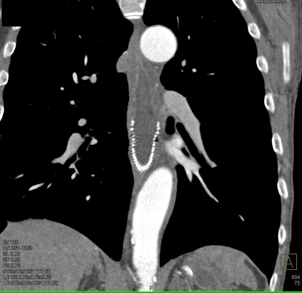 Esophageal Cancer with Stent - CTisus CT Scan