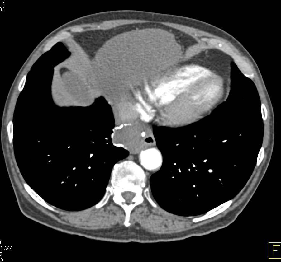 Leiomyoma Esophagus - CTisus CT Scan