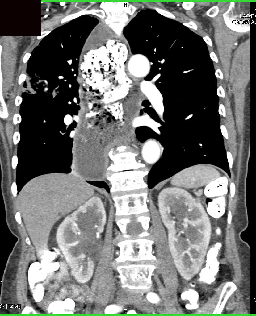 Dilated Esophagus with Retained Food and Contrast - CTisus CT Scan