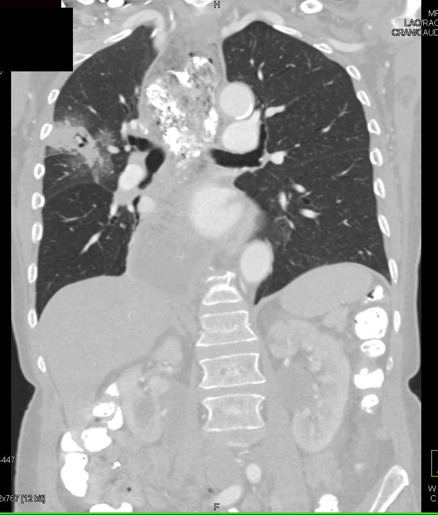 Dilated Esophagus with Retained Food and Contrast - CTisus CT Scan